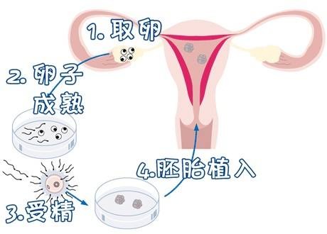 借卵代怀选性别